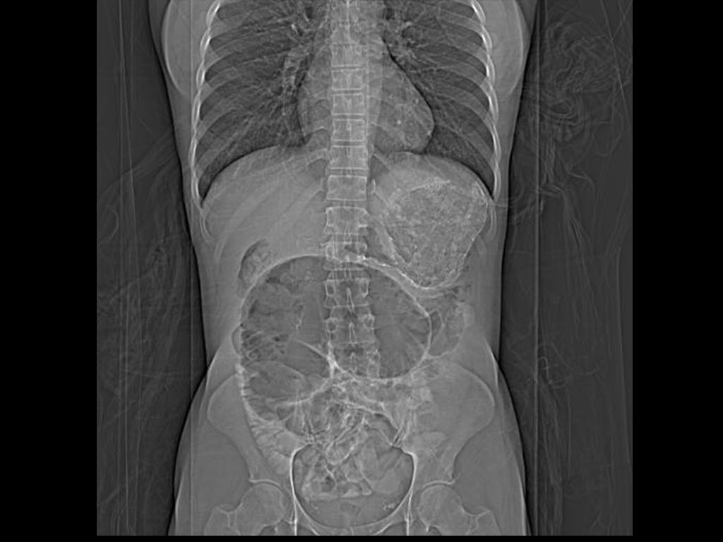 coffee bean volvulus