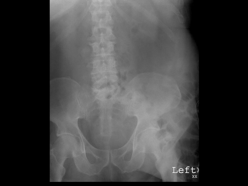 icd 9 code for abdominal distension