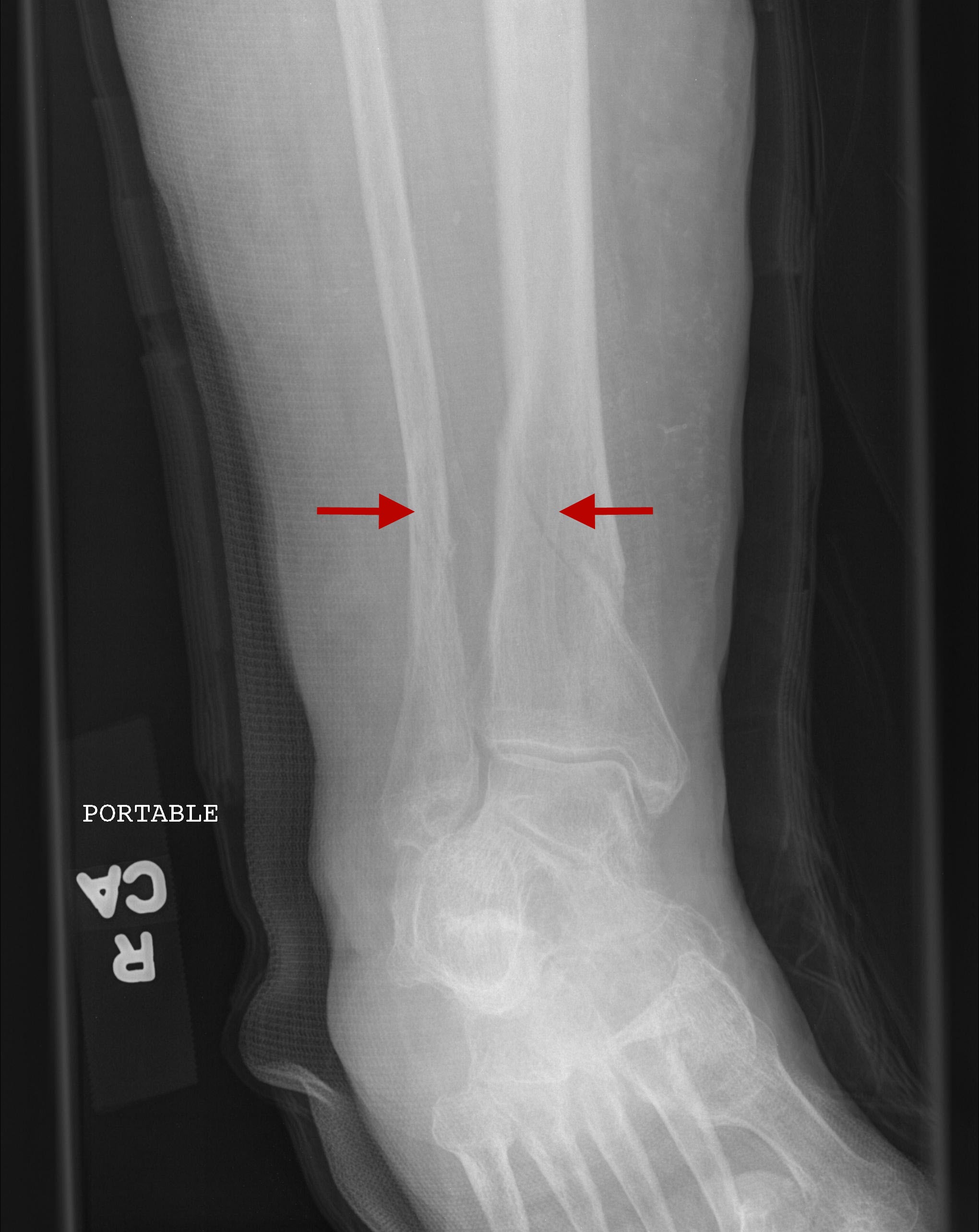 icd 10 code for stress fracture left tibia