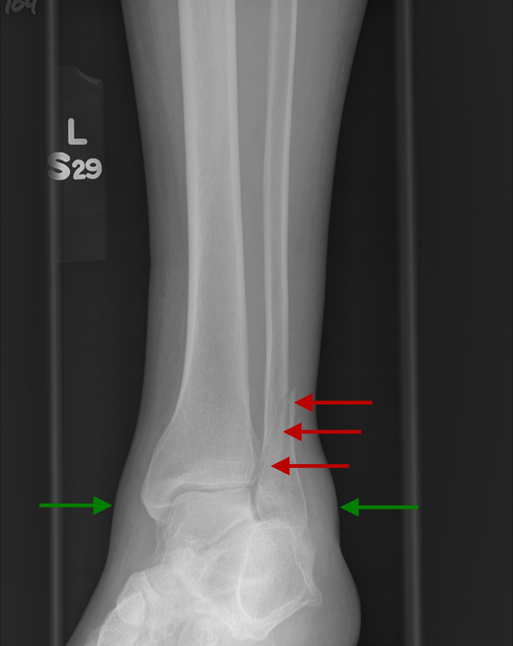 Fracture Fibula Daqas