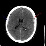 Bilateral subdural hematomas and parenchymal bleed