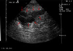 Right hydrosalpinx and uterine fibroids