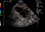 Right hydrosalpinx and uterine fibroids
