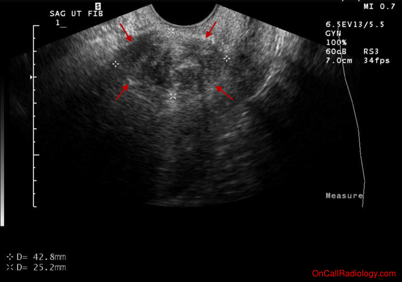 Female (Right hydrosalpinx and uterine fibroids - Ultrasound, CT)