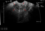 Right hydrosalpinx and uterine fibroids