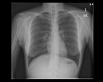 Normal Chest