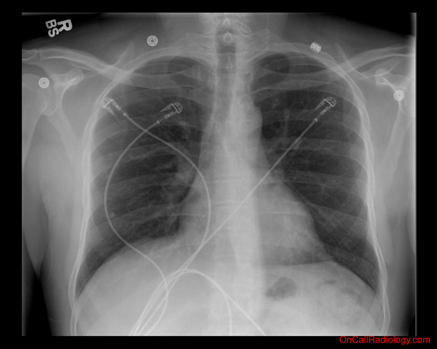 Harmless (Calcified Granuloma - Plain film, Radiograph)