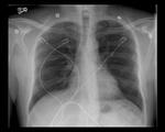 Calcified Granuloma