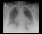Calcified lymph nodes