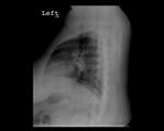 Calcified lymph nodes