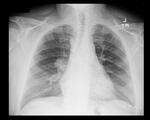 Lung cancer