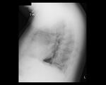 Lung cancer