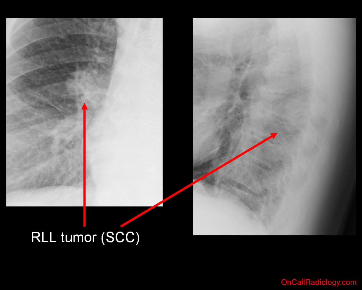 Cancer (Lung cancer - Plain film, Radiograph)