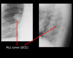 Lung cancer