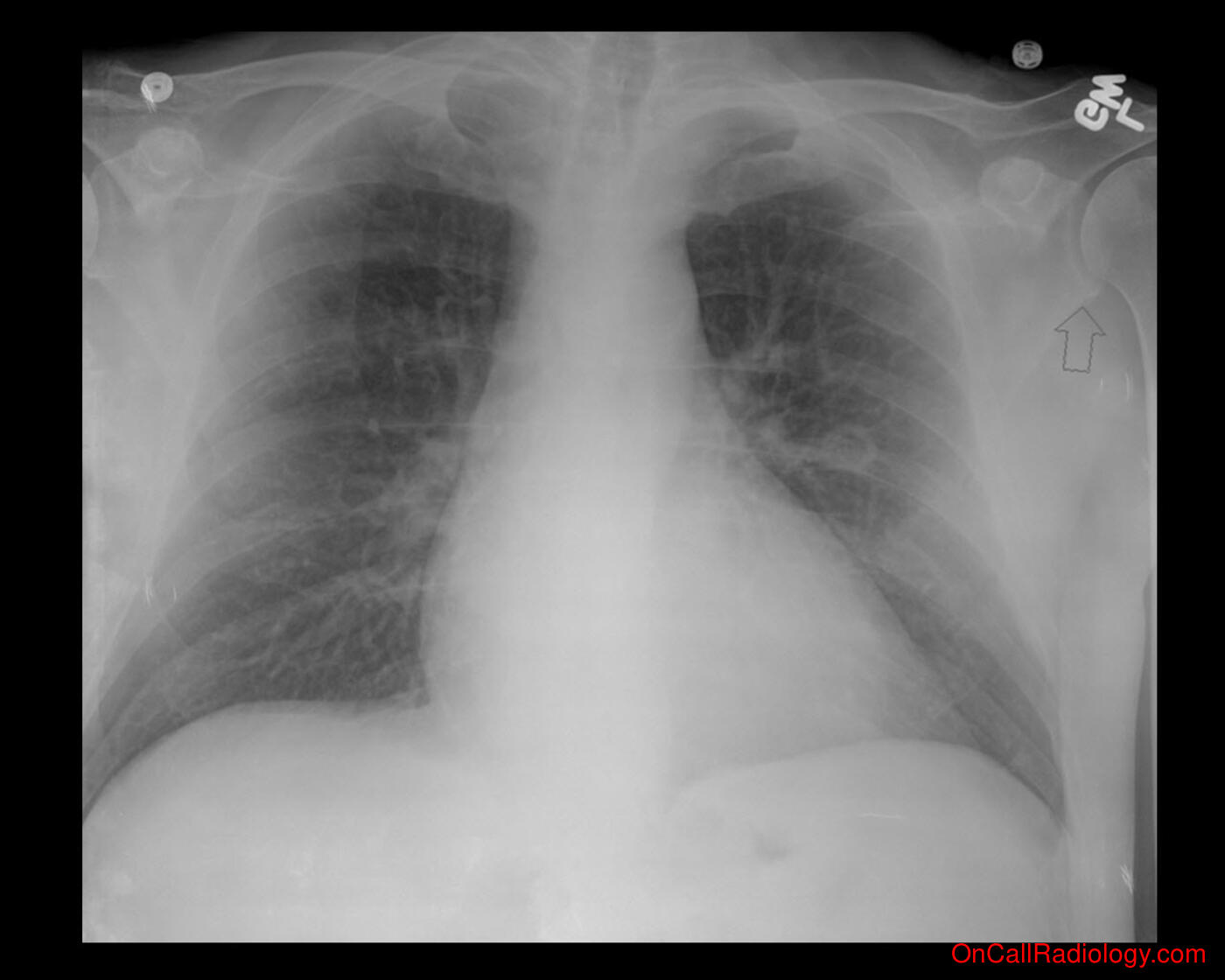 Technique (Proper technique important!  - Plain film, Radiograph)