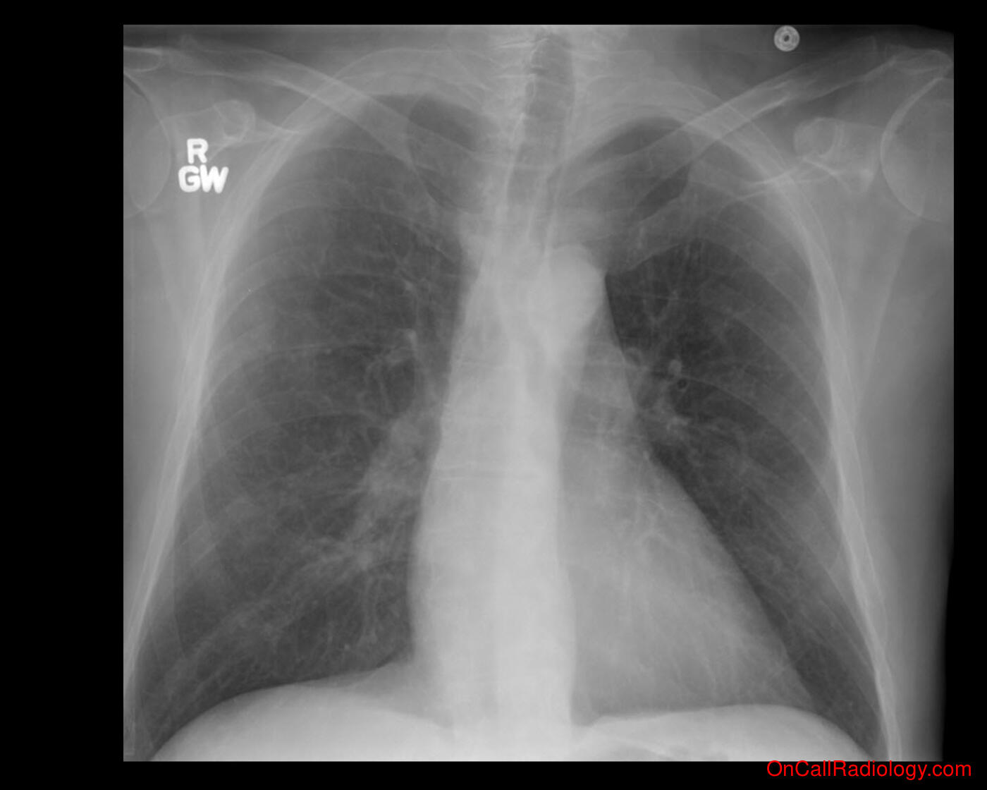 Technique (Proper technique important!  - Plain film, Radiograph)