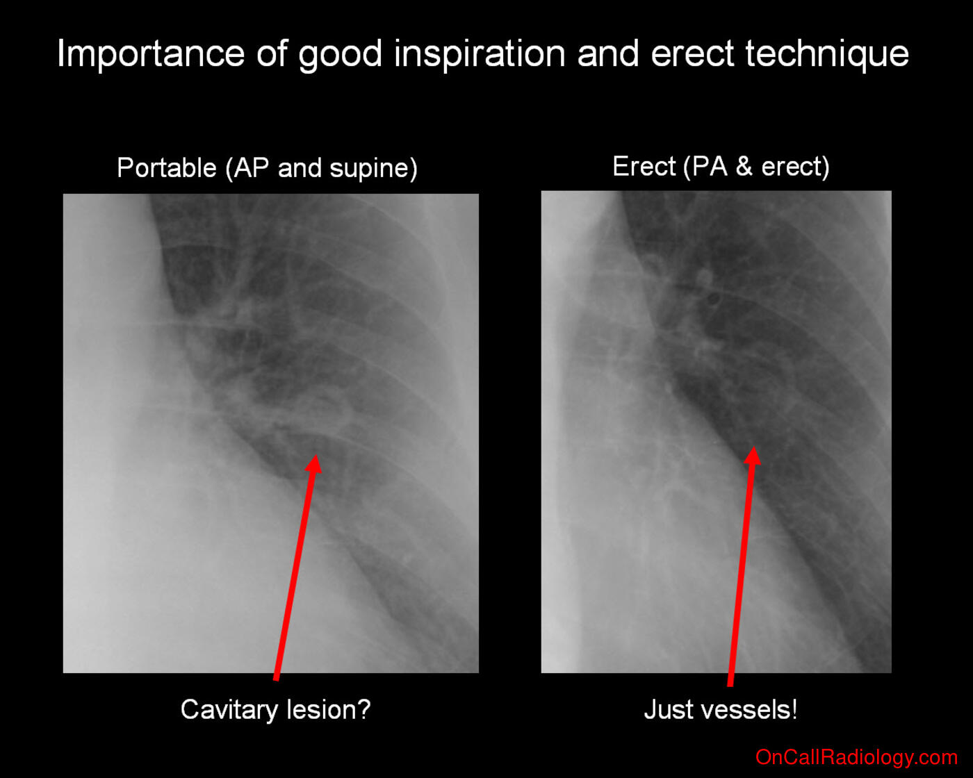 Technique (Proper technique important!  - Plain film, Radiograph)