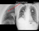 Large pneumothorax