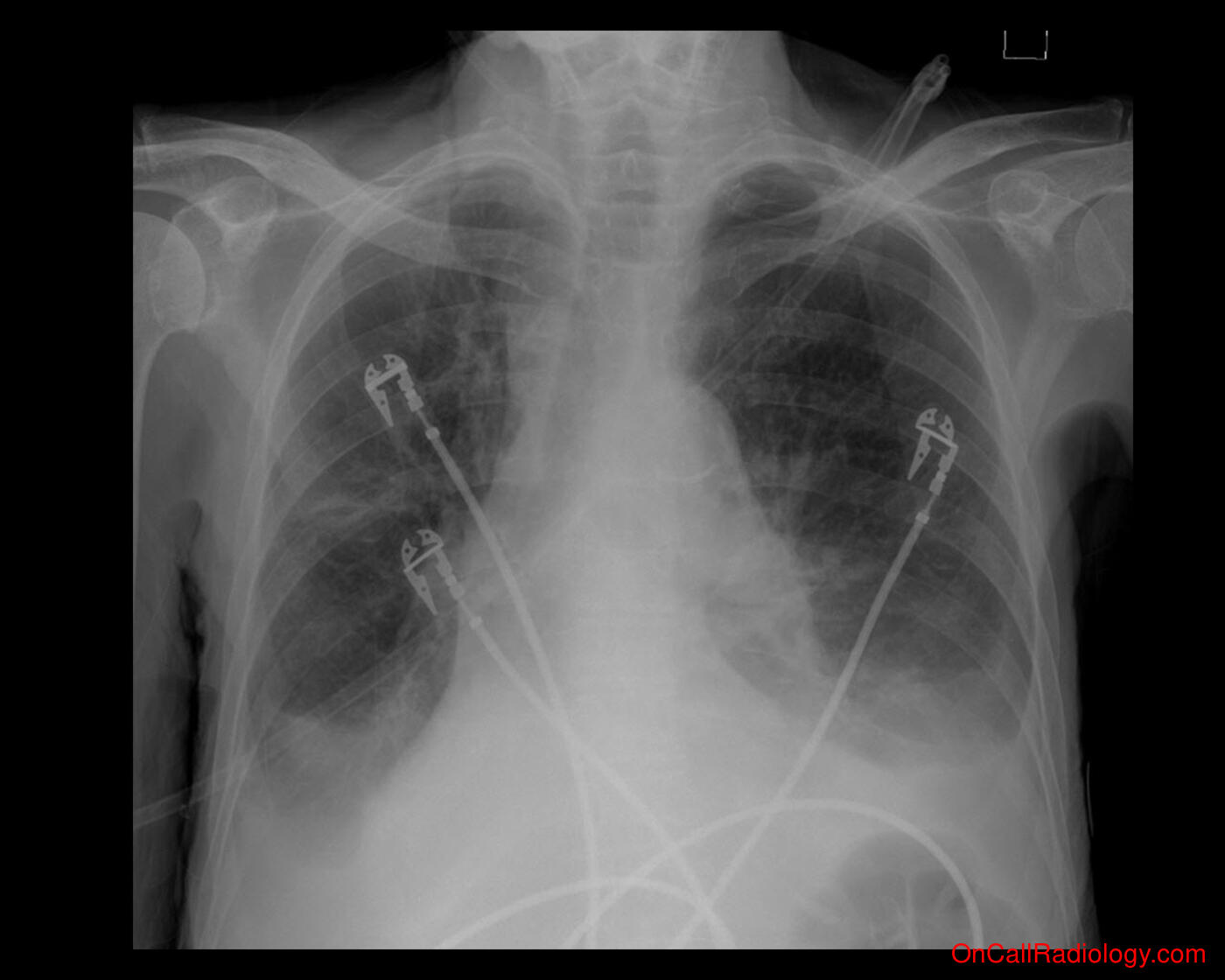 Pneumothorax (Small pneumothorax - Plain film, Radiograph)