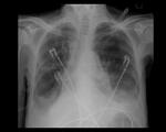 Small pneumothorax