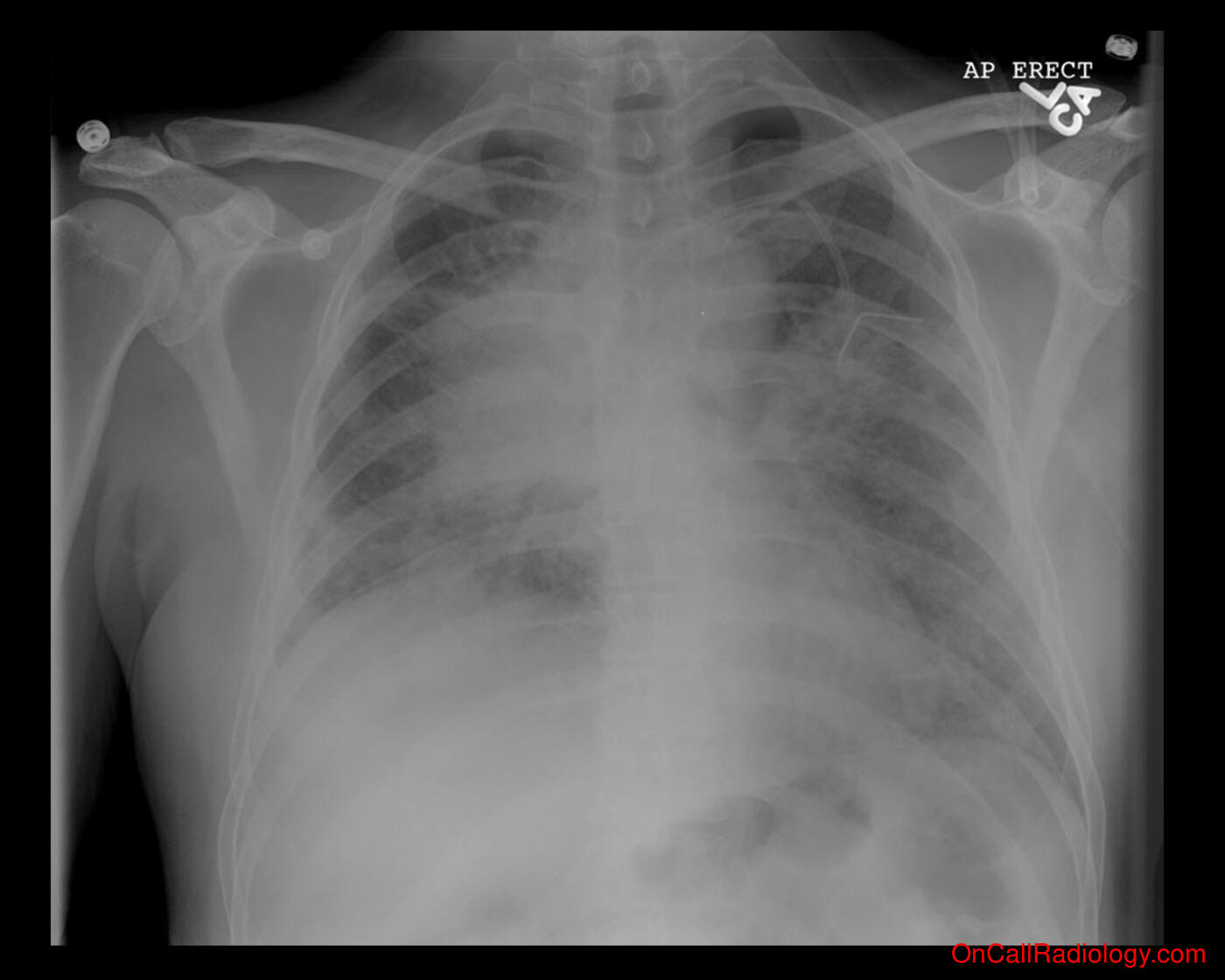 Pneumothorax (Small pneumothorax - Plain film, Radiograph)