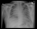 Small pneumothorax