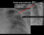 Small pneumothorax