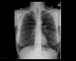 Small costophrenic pneumothorax