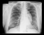 Aortic aneurysm