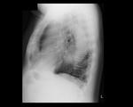 Aortic aneurysm