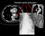Aortic aneurysm
