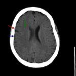 Acute right MCA stroke
