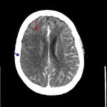 Acute right MCA stroke