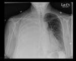 Pleural effusion