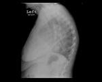 Pleural effusion