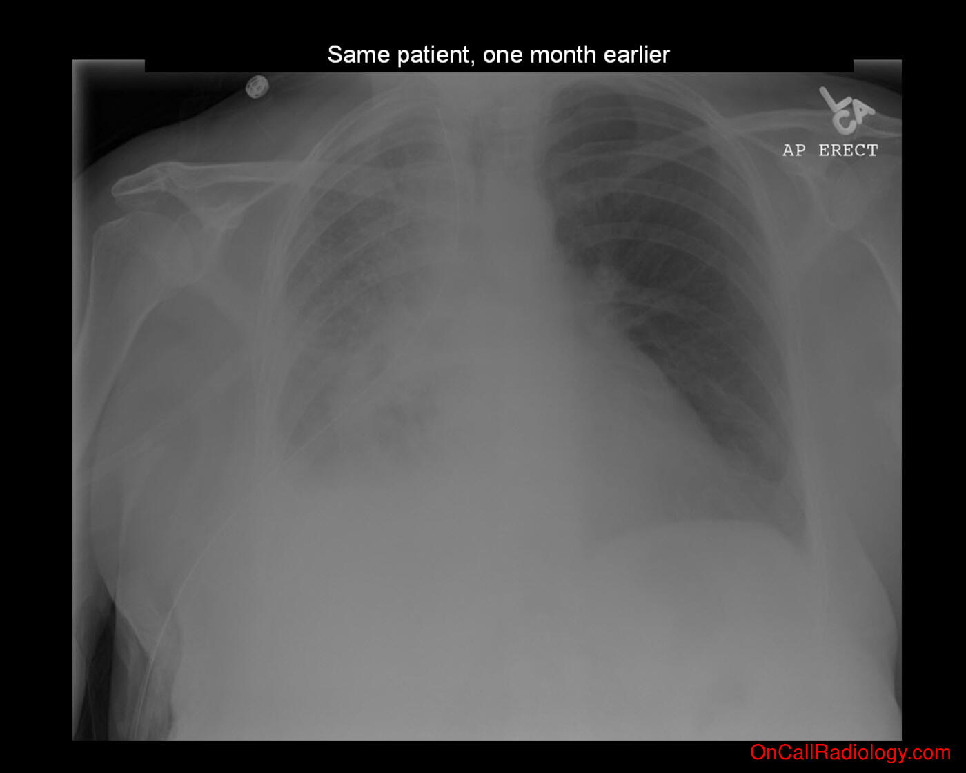 Fluid (Pleural effusion - Plain film, Radiograph, CT, Computed tomography)