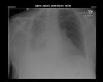 Pleural effusion