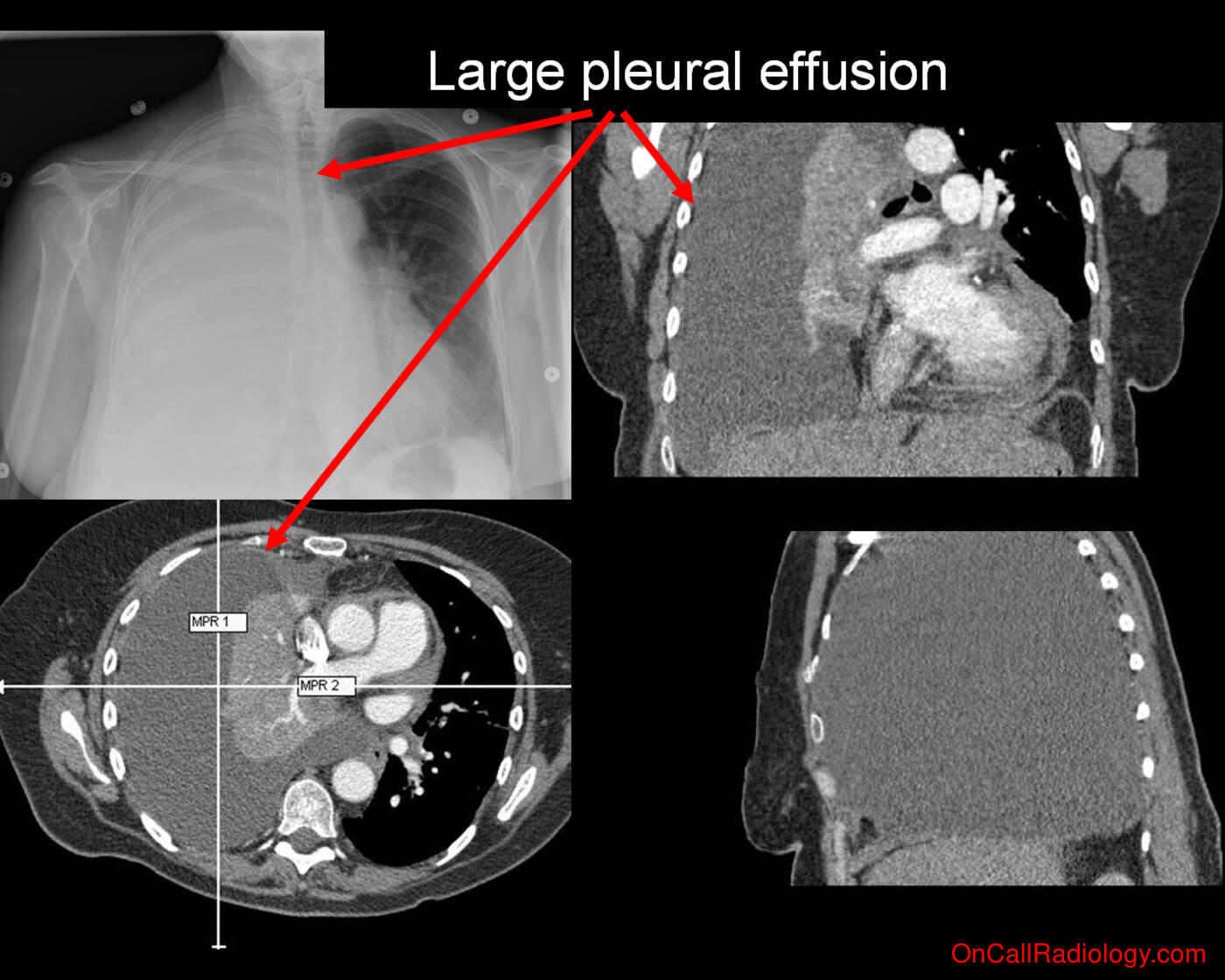 Fluid (Pleural effusion - Plain film, Radiograph, CT, Computed tomography)
