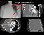 Pleural effusion