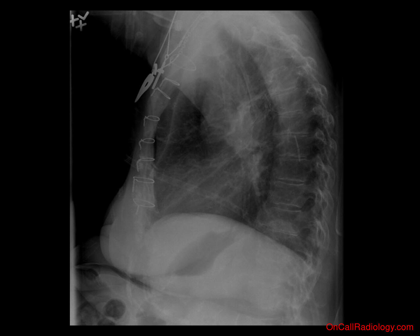 Lung volume (Volume loss  - Plain film, Radiograph)