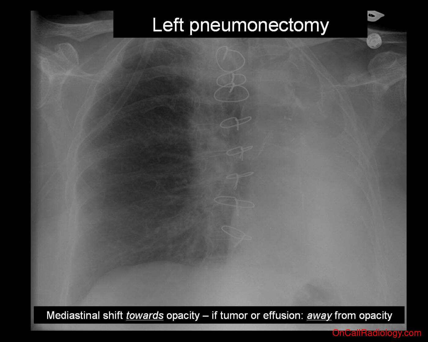 Lung volume (Volume loss  - Plain film, Radiograph)