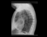 Obstructive lung disease