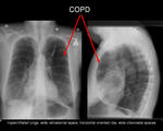 Obstructive lung disease