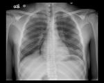 Left and right lower lobe pneumonia 
