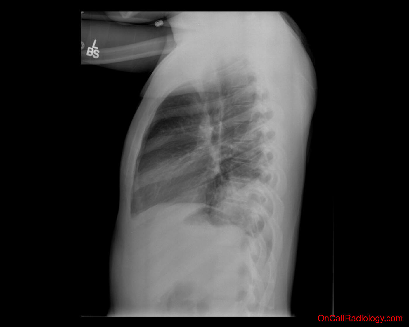 Pneumonia (Left and right lower lobe pneumonia  - Plain film, Radiograph)