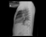 Left and right lower lobe pneumonia 