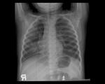 Right middle lobe pneumonia 
