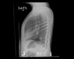Right middle lobe pneumonia 