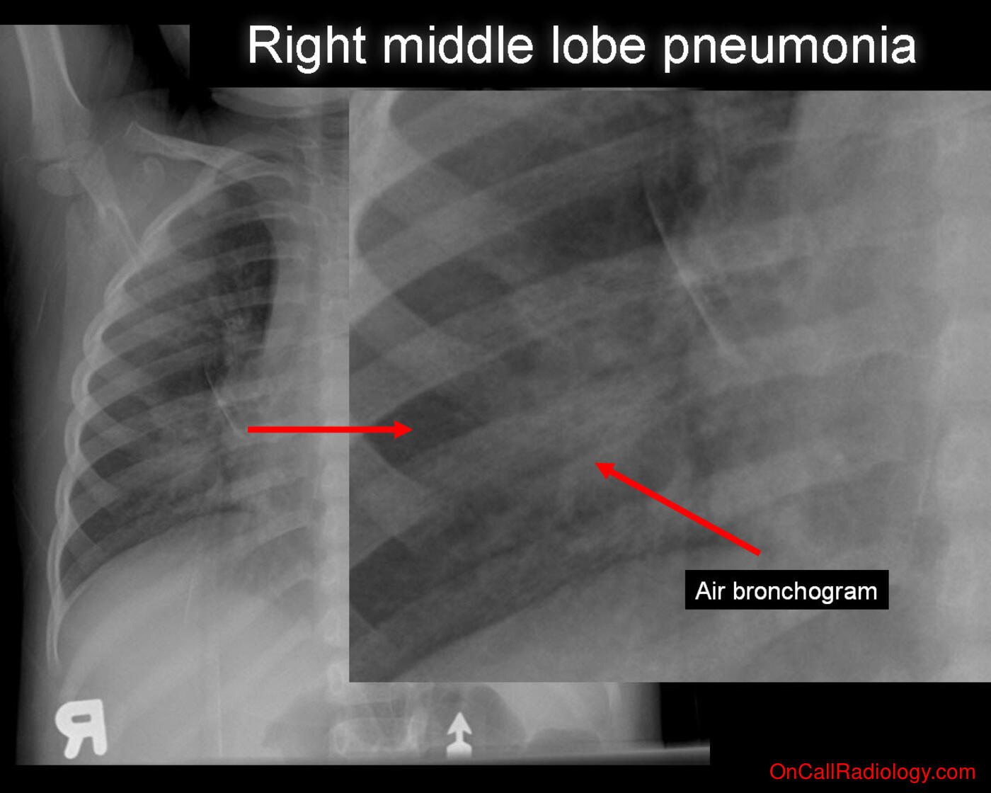 Pneumonia (Right middle lobe pneumonia  - Plain film, Radiograph)