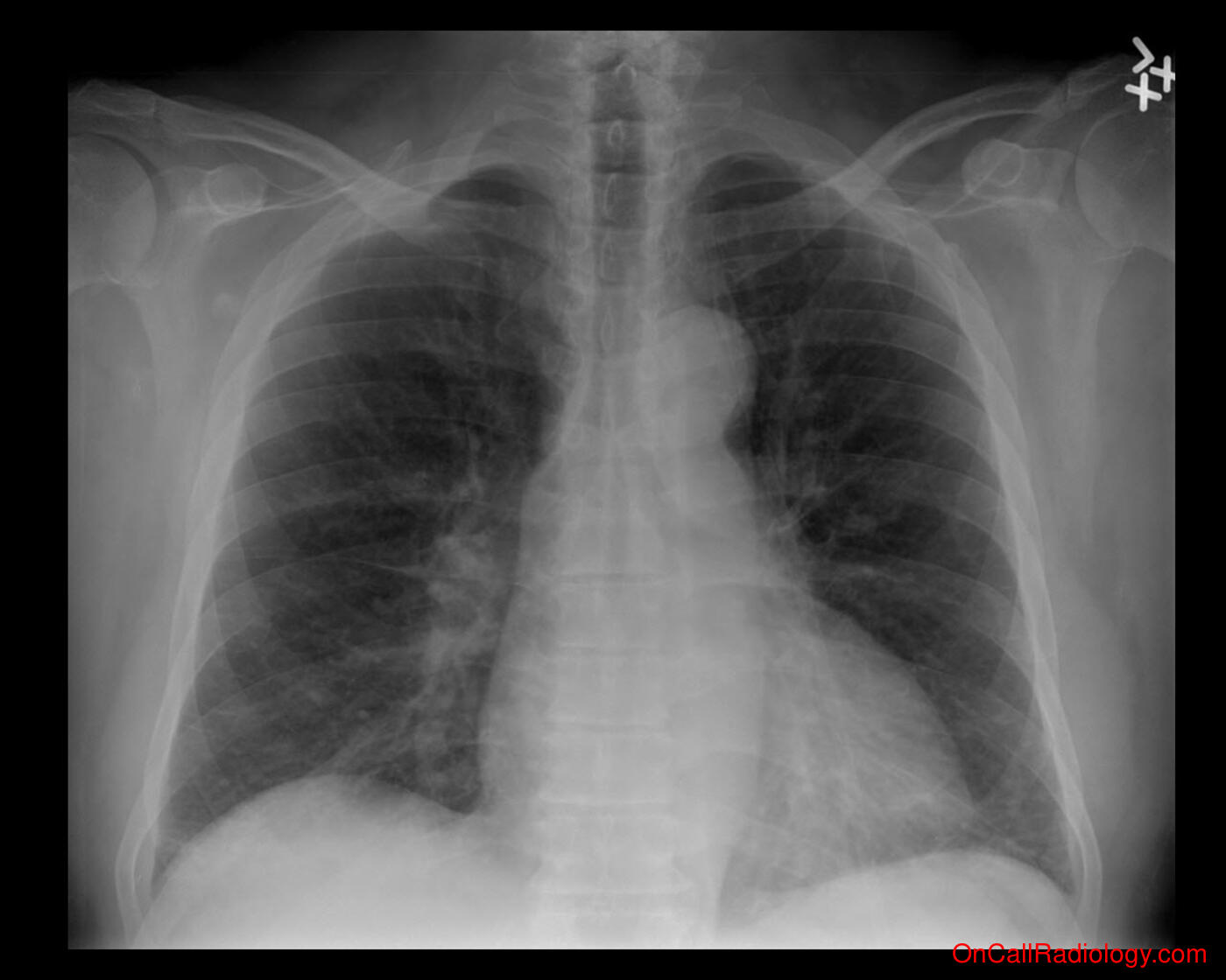 CHF (Mild CHF - Plain film, Radiograph)